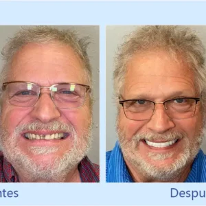 DIYSTAR™ - Prótesis Dental Premium