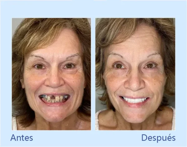 DIYSTAR™ - Prótesis Dental Premium